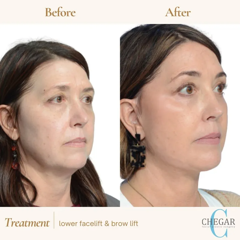 Before and after — Dr. Burke Chegar