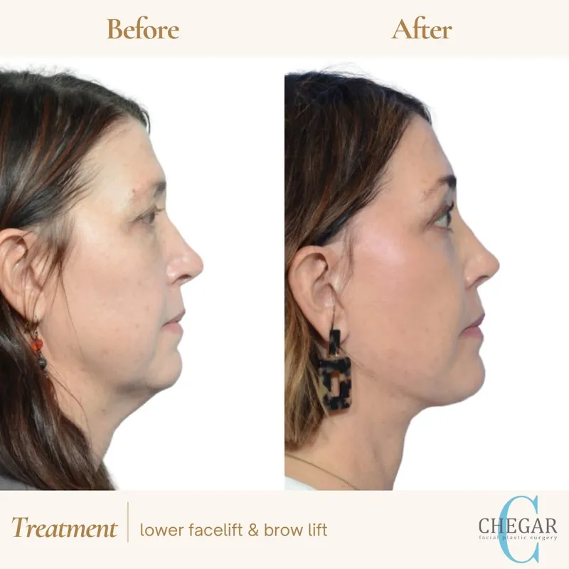 Before and after — Dr. Burke Chegar