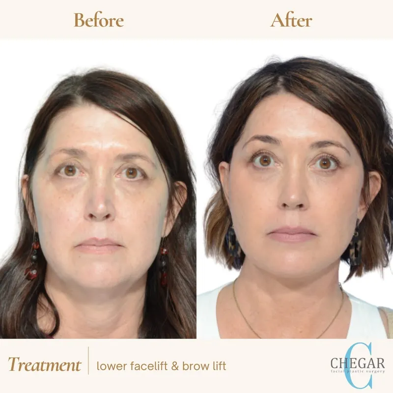 Before and after — Dr. Burke Chegar