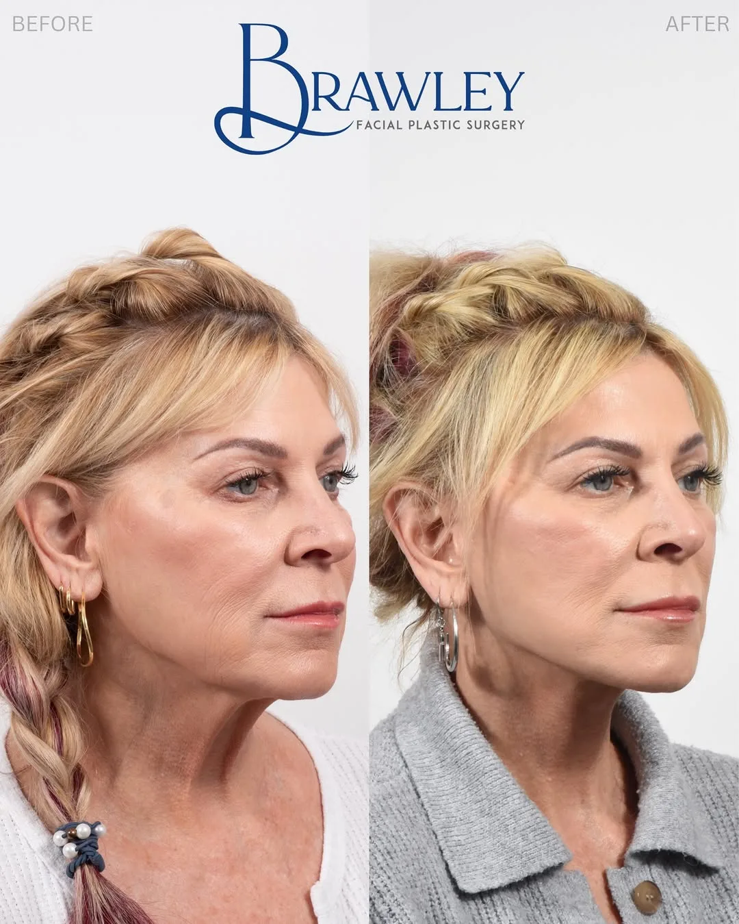 Before and after deep plane facelift — 52-year-old woman, three-quarter view, 12mo post-op by Dr. Cameron Brawley