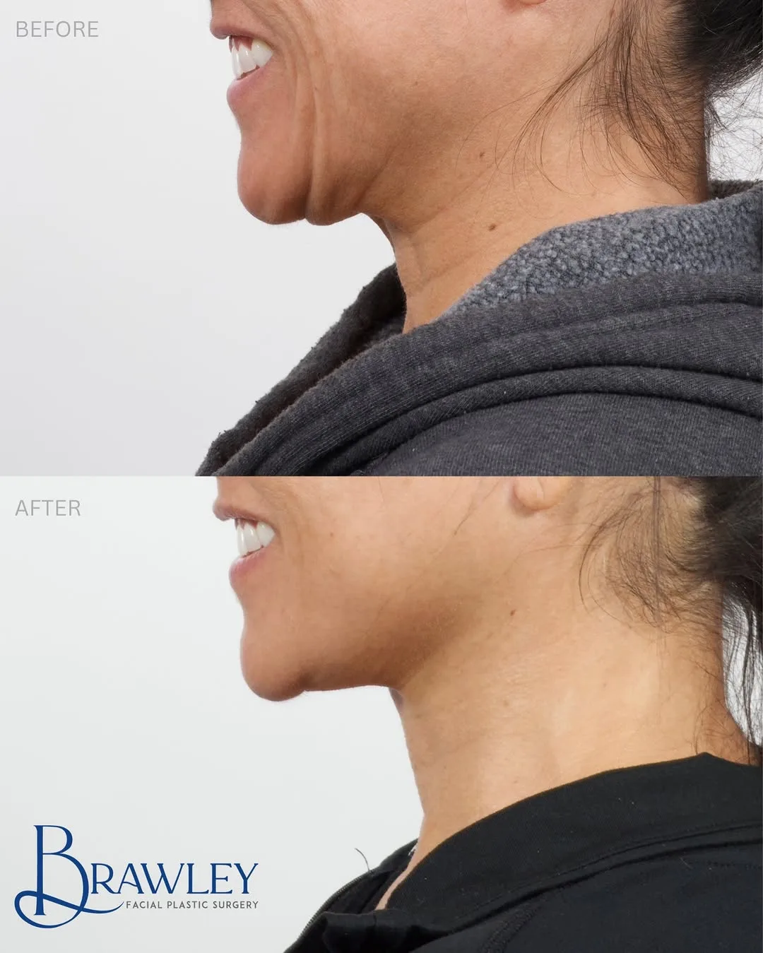 Before and after deep plane facelift — 45-year-old woman, left profile view, 12mo post-op by Dr. Cameron Brawley