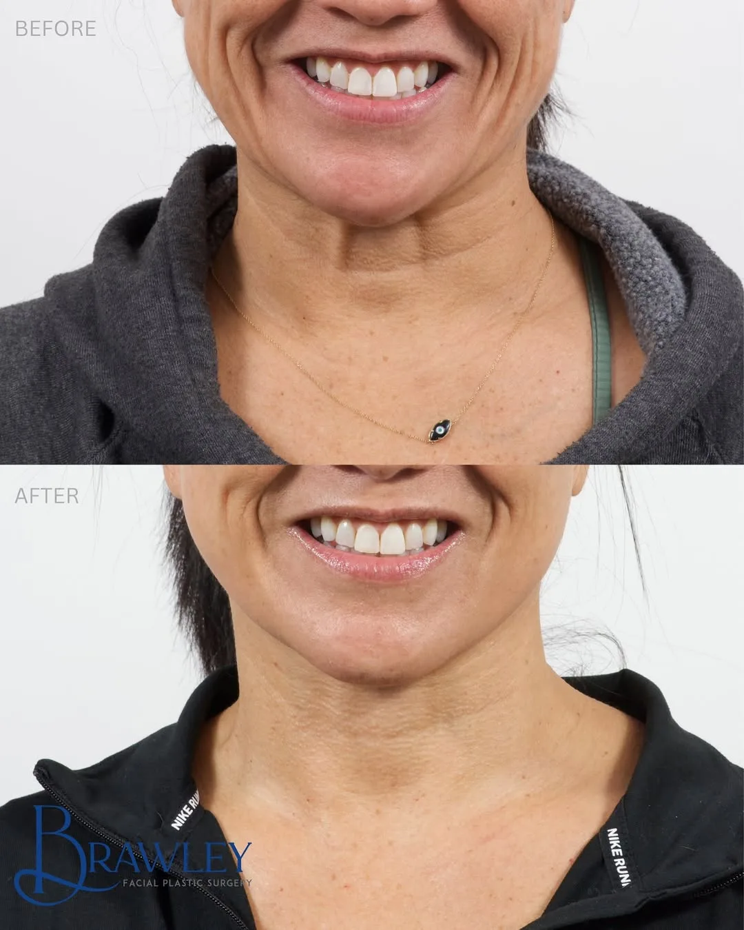 Before and after deep plane facelift — 45-year-old woman, frontal view, 12mo post-op by Dr. Cameron Brawley
