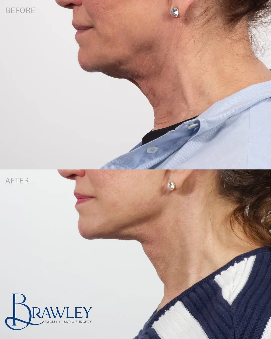 Before and after deep plane facelift — 55-year-old woman, three-quarter view, 12mo post-op by Dr. Cameron Brawley