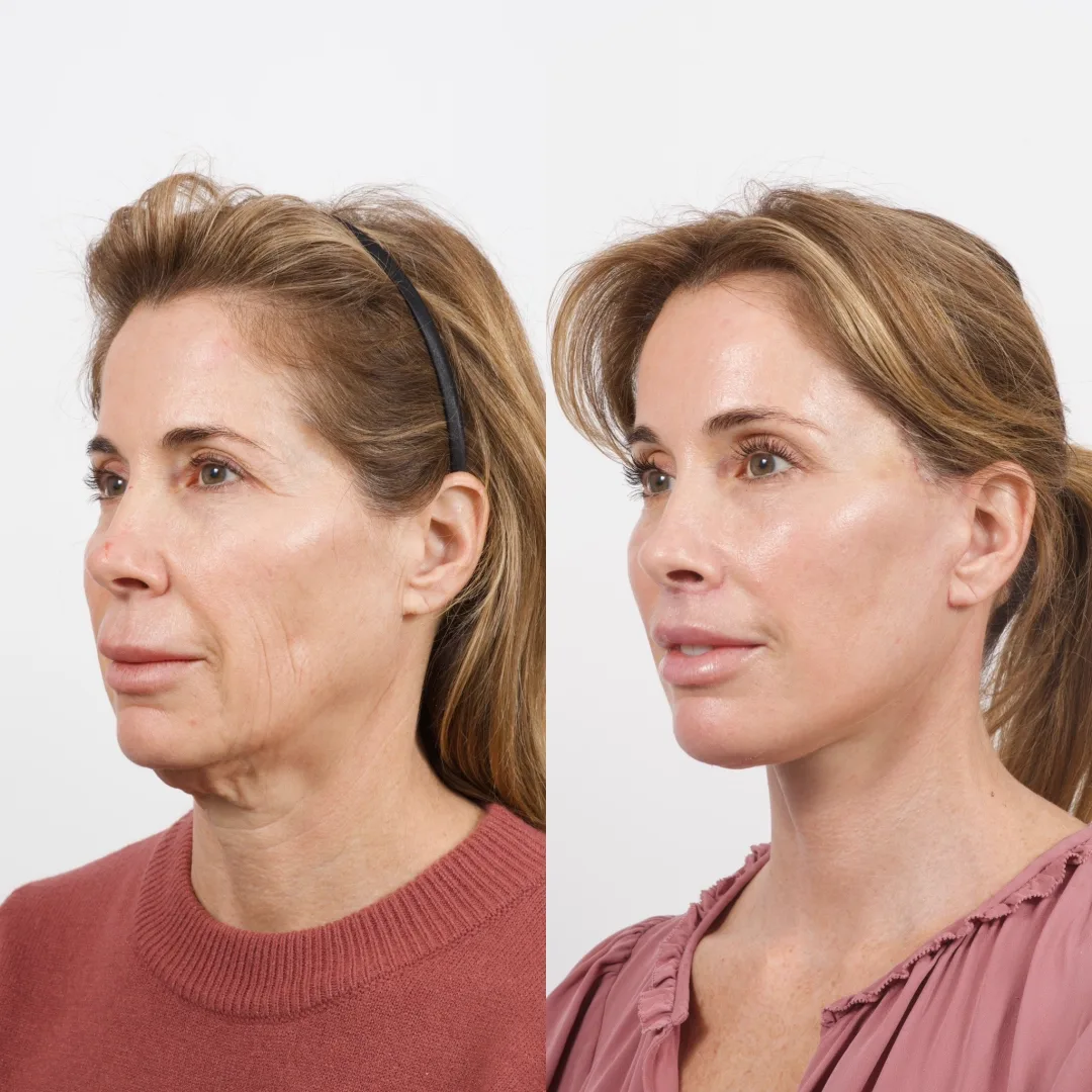 Before and after deep plane facelift — 52-year-old woman, left profile view, 9mo post-op by Dr. Cameron Brawley