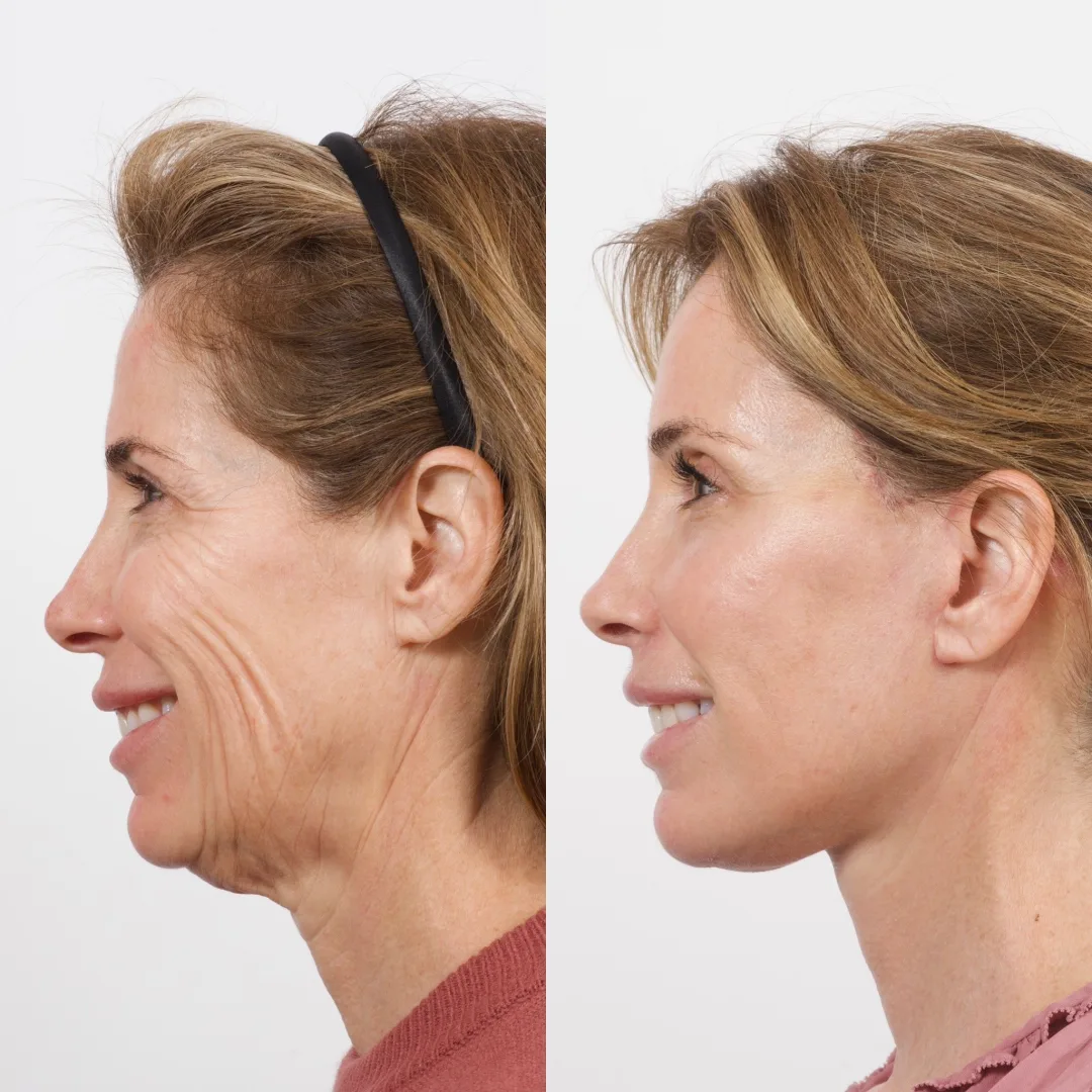 Before and after deep plane facelift — 55-year-old woman, left profile view, 7mo post-op by Dr. Cameron Brawley