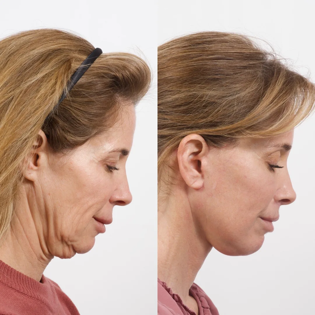 Before and after deep plane facelift — 55-year-old woman, right profile view, 9mo post-op by Dr. Cameron Brawley
