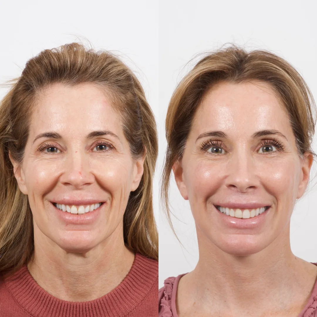 Before and after deep plane facelift — 48-year-old woman, frontal view, 7mo post-op by Dr. Cameron Brawley
