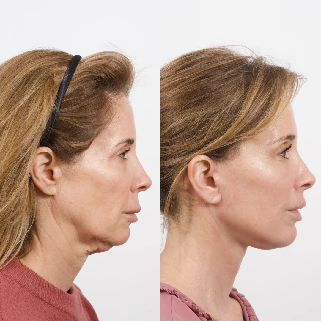 Before and after deep plane facelift — 55-year-old woman, right profile view, 6mo post-op by Dr. Cameron Brawley