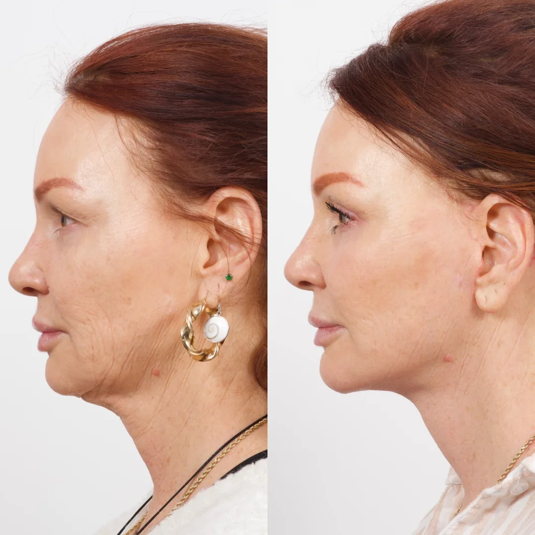 Before and after deep plane facelift — 52-year-old woman, left profile view, 7mo post-op by Dr. Cameron Brawley