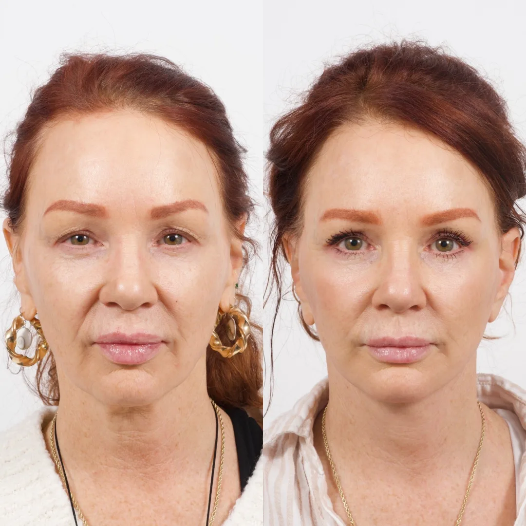 Before and after deep plane facelift — 52-year-old woman, frontal view, 7mo post-op by Dr. Cameron Brawley