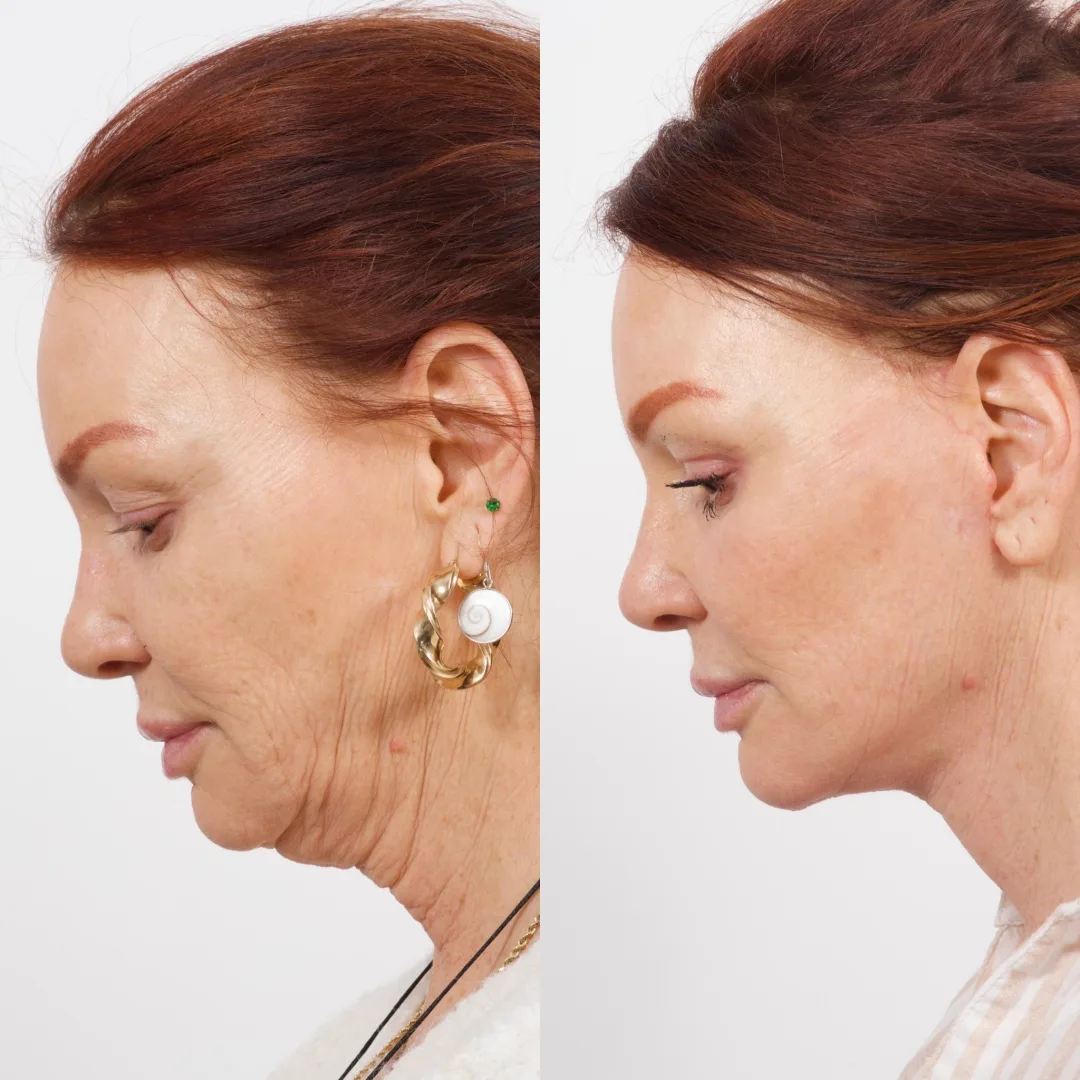 Before and after deep plane facelift — 58-year-old woman, right profile view, 9mo post-op by Dr. Cameron Brawley