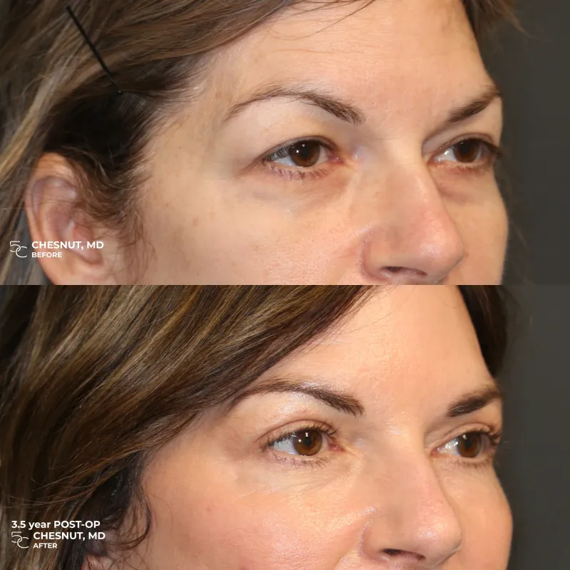 До и после — Lower Eyelid Surgery от доктора Cameron Chesnut