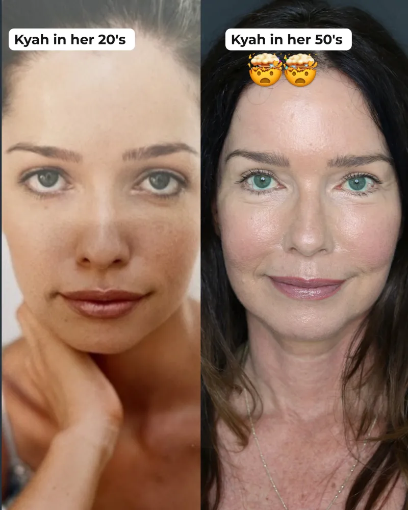 Before & After - Deep Plane Facelift by Dr. Cameron Chesnut