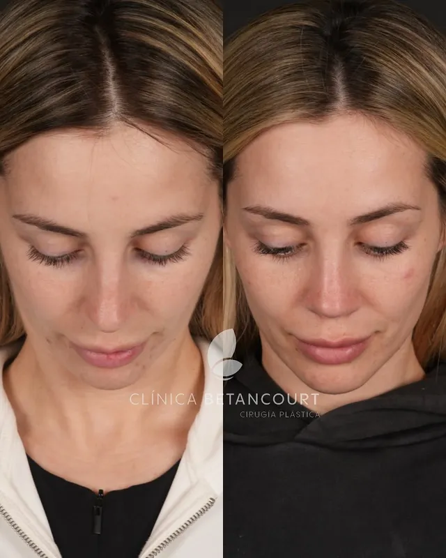 Before and after deep plane facelift — -1-year-old patient, frontal view by Dr. Camilo Betancourt