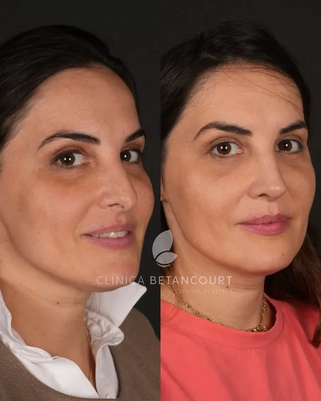 Before and after deep plane facelift — -1-year-old patient, frontal view by Dr. Camilo Betancourt