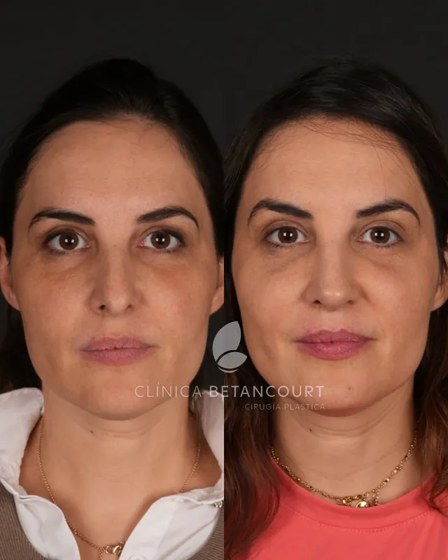 Before and after deep plane facelift — -1-year-old patient, frontal view by Dr. Camilo Betancourt