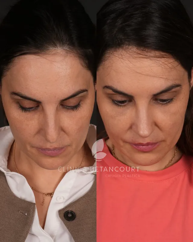 Before and after deep plane facelift — -1-year-old patient, frontal view by Dr. Camilo Betancourt