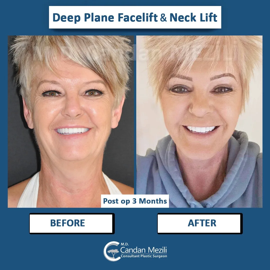 Before and after deep plane facelift — 58-year-old woman, frontal view, 3mo post-op by Dr. Candan Mezili