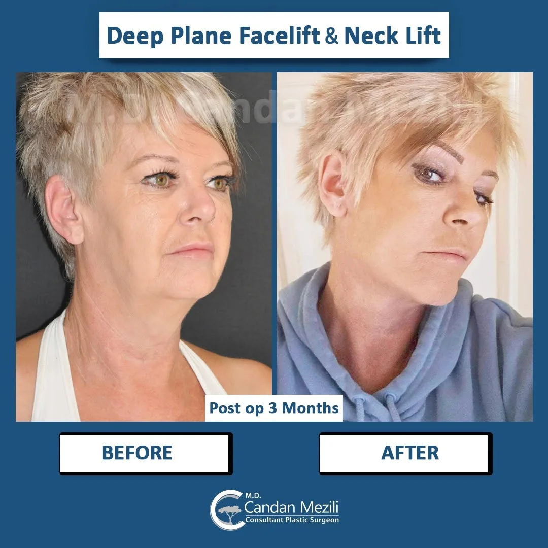 Before and after deep plane facelift — 58-year-old woman, oblique right view, 3mo post-op by Dr. Candan Mezili
