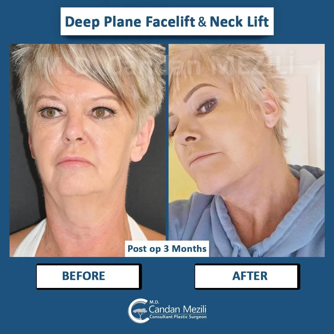 Before and after deep plane facelift — 58-year-old woman, oblique right view, 3mo post-op by Dr. Candan Mezili