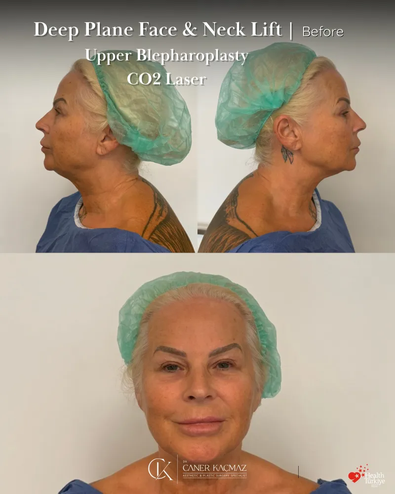 Before and after: Dr. Caner Kaçmaz