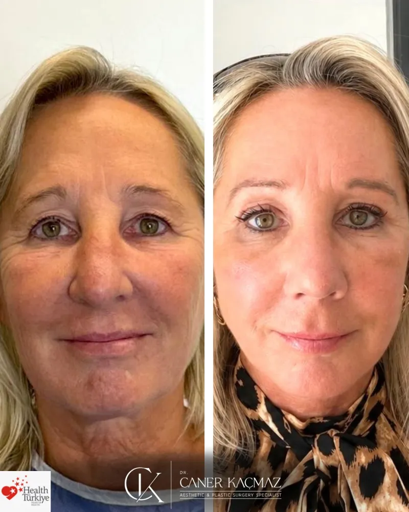 Before and after: Dr. Caner Kaçmaz