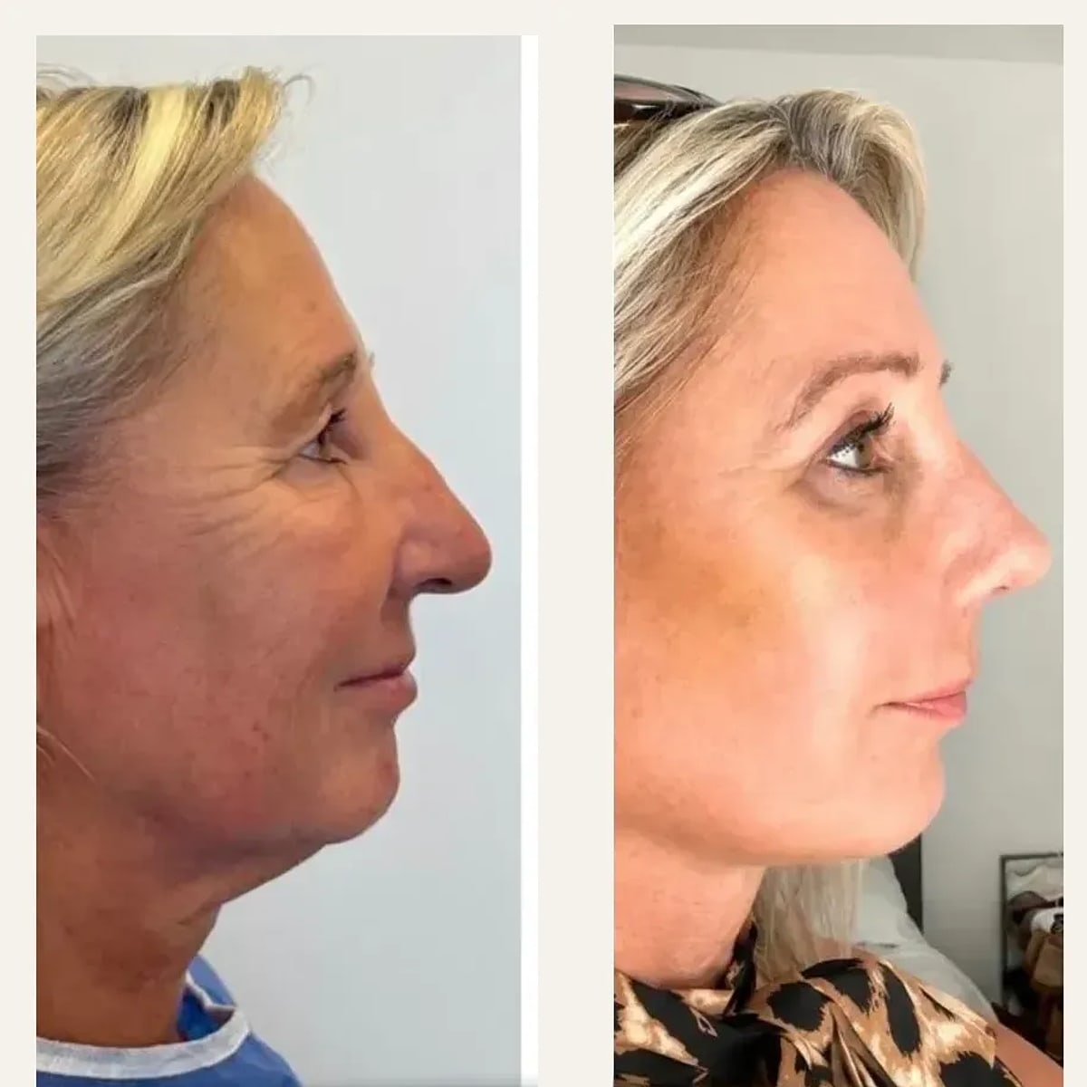 Before and after: Dr. Caner Kaçmaz