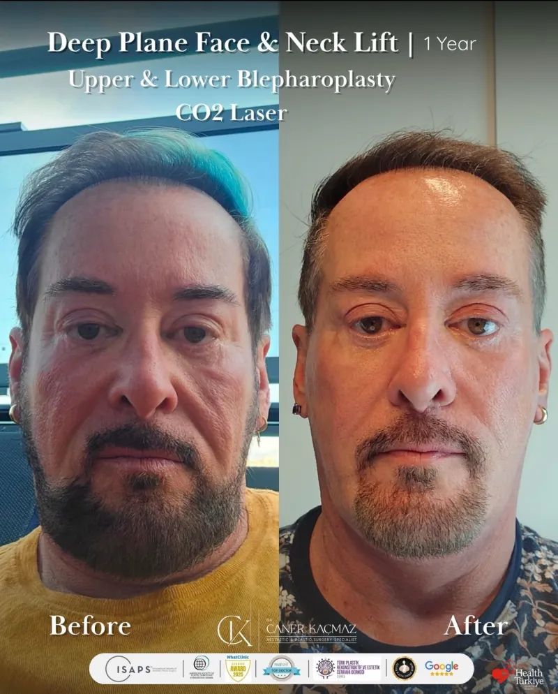 Before and after: Dr. Caner Kaçmaz