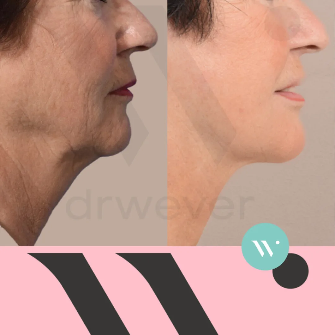 Before and after: Dr. Capi C. Wever