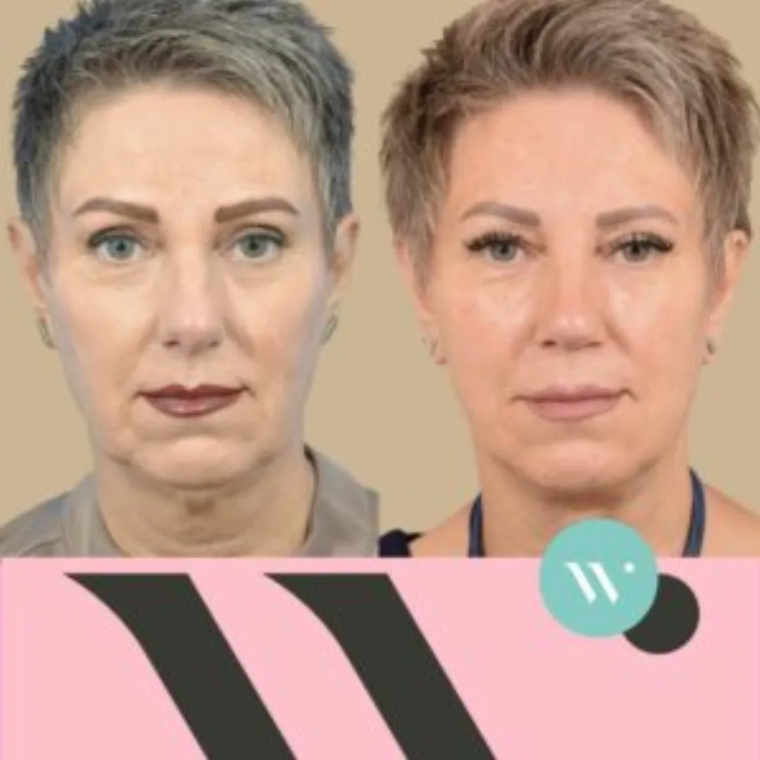 Before and after: Dr. Capi C. Wever