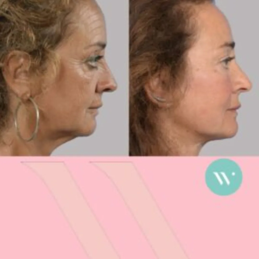 Before & After - Deep Plane Facelift by Dr. Capi C. Wever