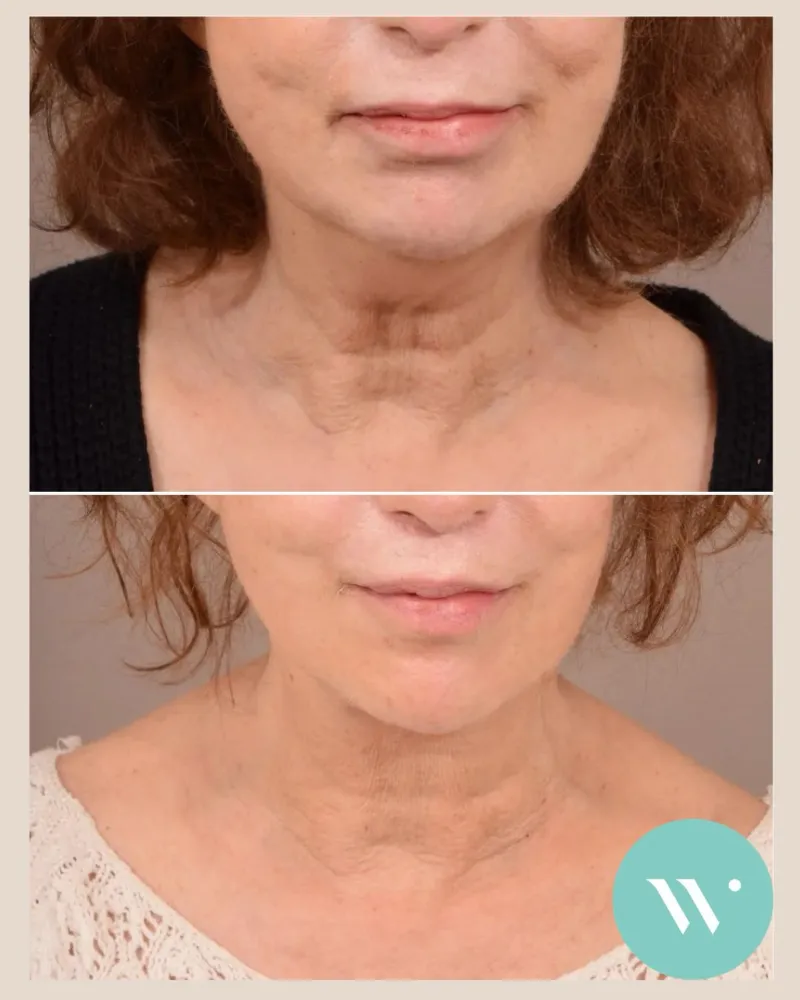 قبل وبعد - Deep Plane Facelift بواسطة د. Capi Wever
