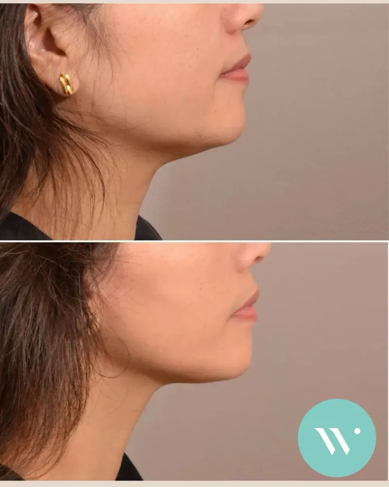 قبل وبعد - Deep Plane Facelift بواسطة د. Capi Wever