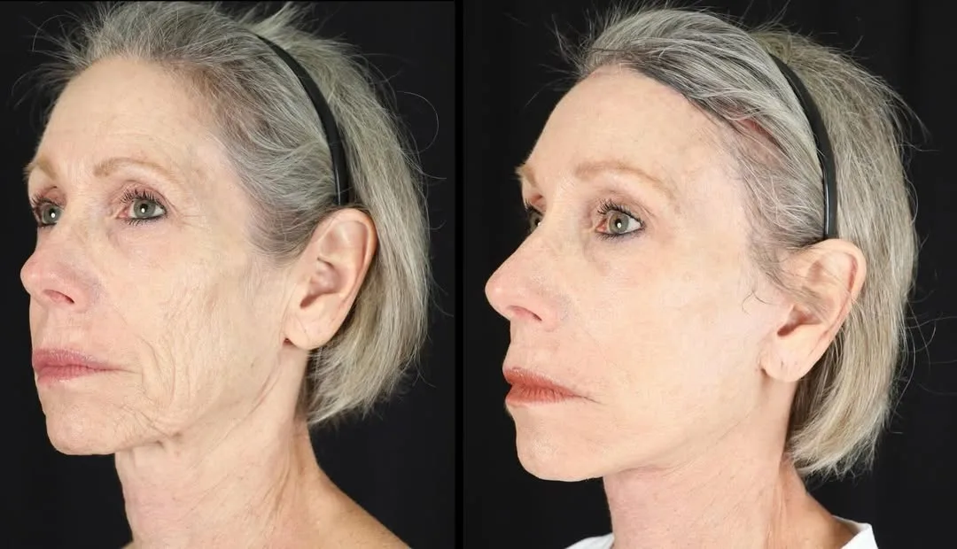 Before and after deep plane facelift — 58-year-old woman, left profile view, 7mo post-op by Dr. Carl Lentz