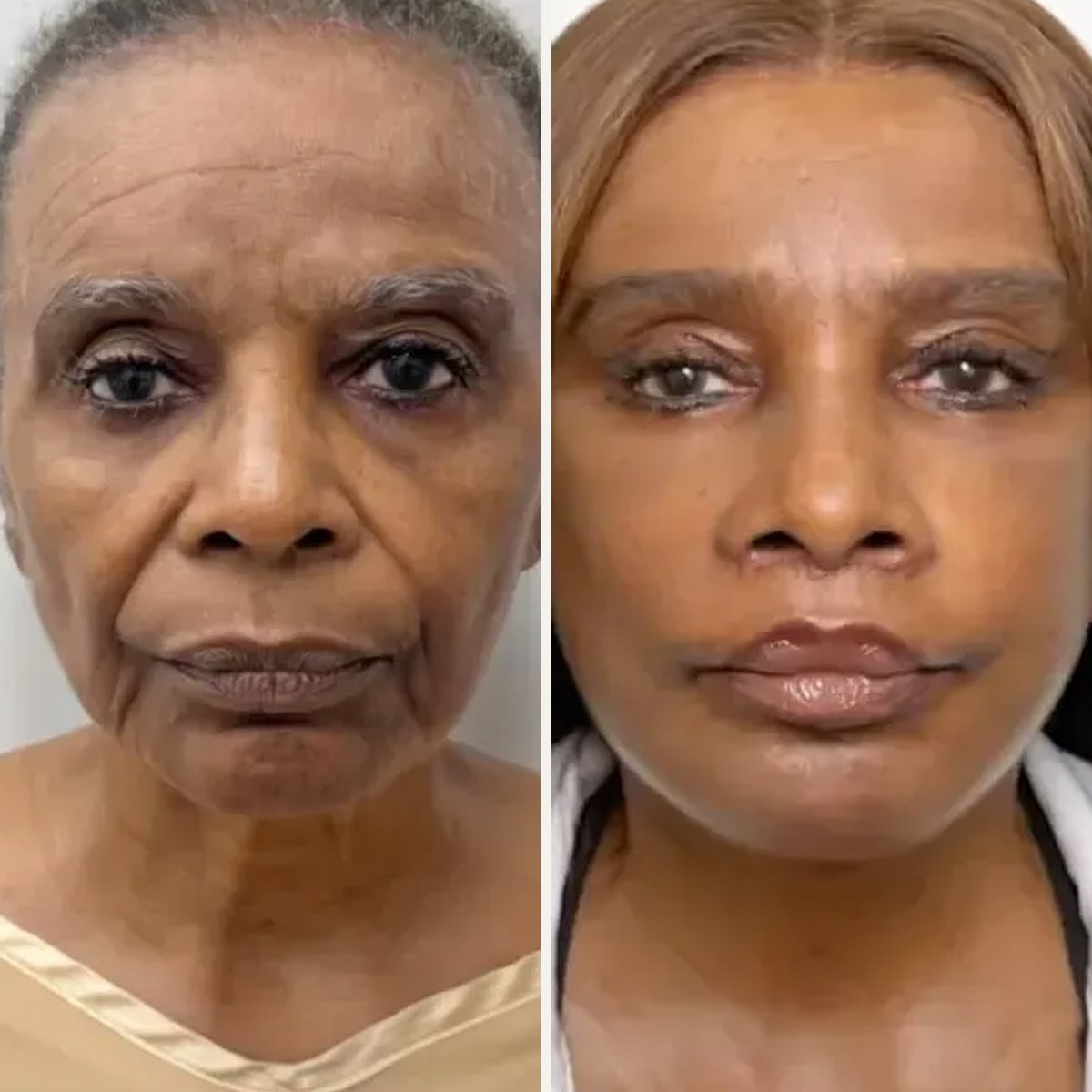 До и после — Deep Plane Facelift от доктора Carl Truesdale
