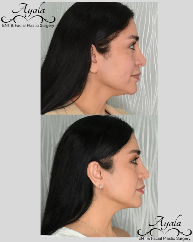 Before and after deep plane facelift, frontal view by Dr. Carlos Ayala