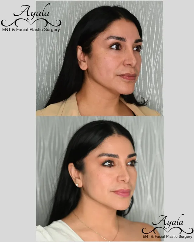 Before and after deep plane facelift, frontal view by Dr. Carlos Ayala