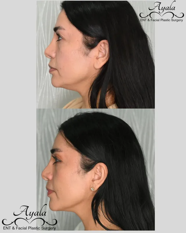 Before and after deep plane facelift, frontal view by Dr. Carlos Ayala