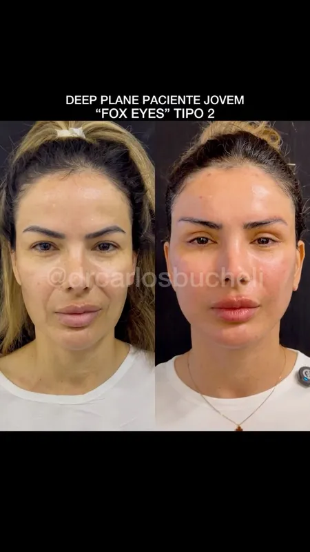 Before and after deep plane facelift — -1-year-old patient, frontal view by Dr. Carlos Bucheli