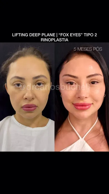 Before and after deep plane facelift — -1-year-old patient, frontal view by Dr. Carlos Bucheli