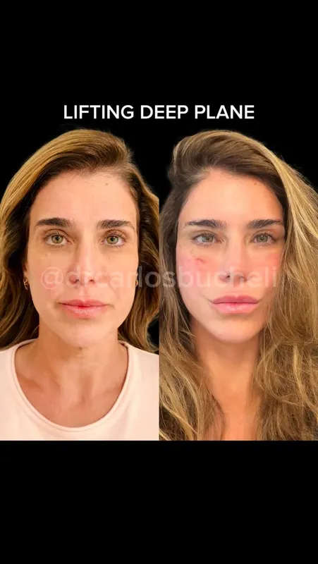 Before and after deep plane facelift — -1-year-old patient, frontal view by Dr. Carlos Bucheli
