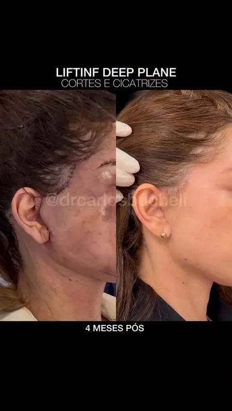 Before and after deep plane facelift — -1-year-old patient, frontal view by Dr. Carlos Bucheli