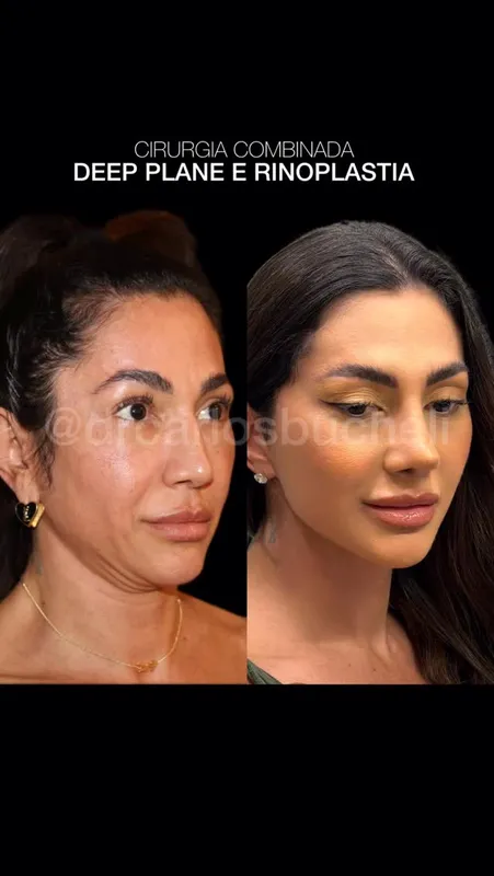 Before and after deep plane facelift — -1-year-old patient, frontal view by Dr. Carlos Bucheli