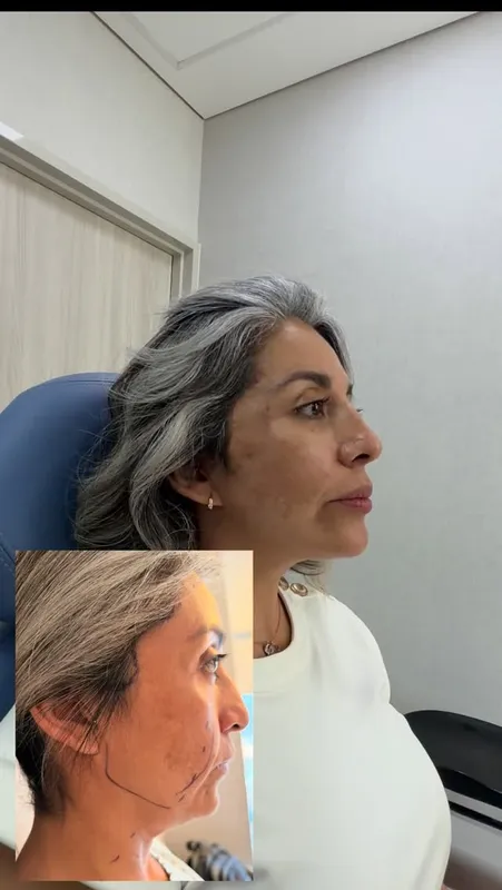 Before and after deep plane facelift — -1-year-old patient, frontal view by Dr. Carlos Perez