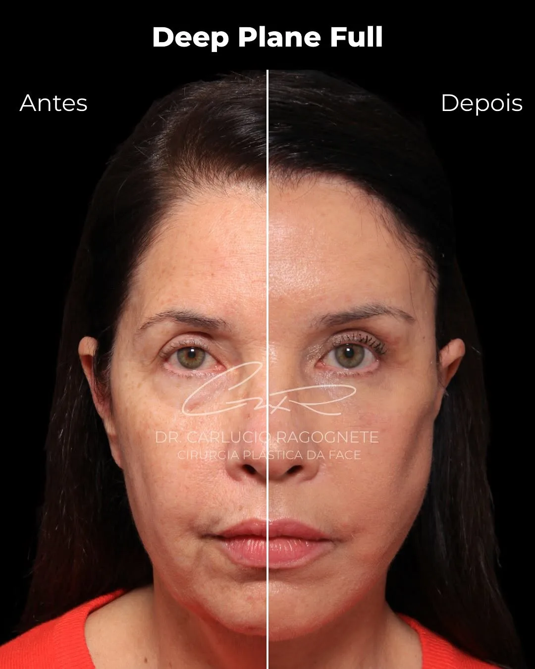 Before and after — Dr. Carlúcio Jereissati