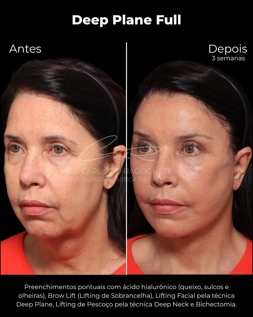 Before and after — Dr. Carlúcio Jereissati