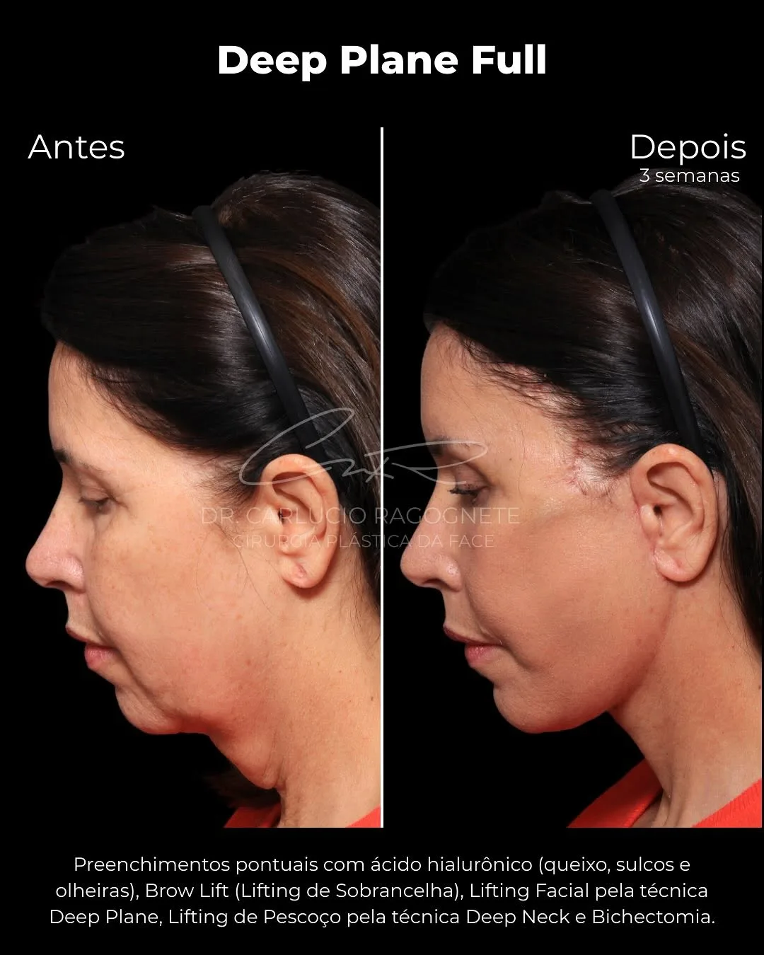 Before and after — Dr. Carlúcio Jereissati