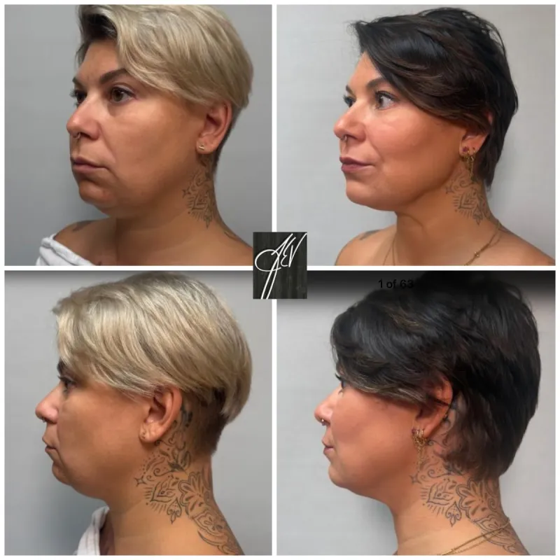 قبل وبعد - Deep Plane Facelift بواسطة د. Carrie Houssock