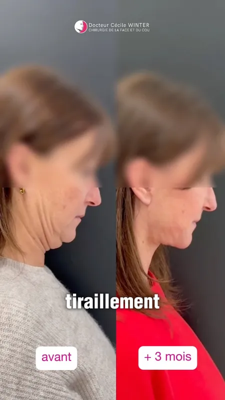 Before and after — Dr. Cecile Winter