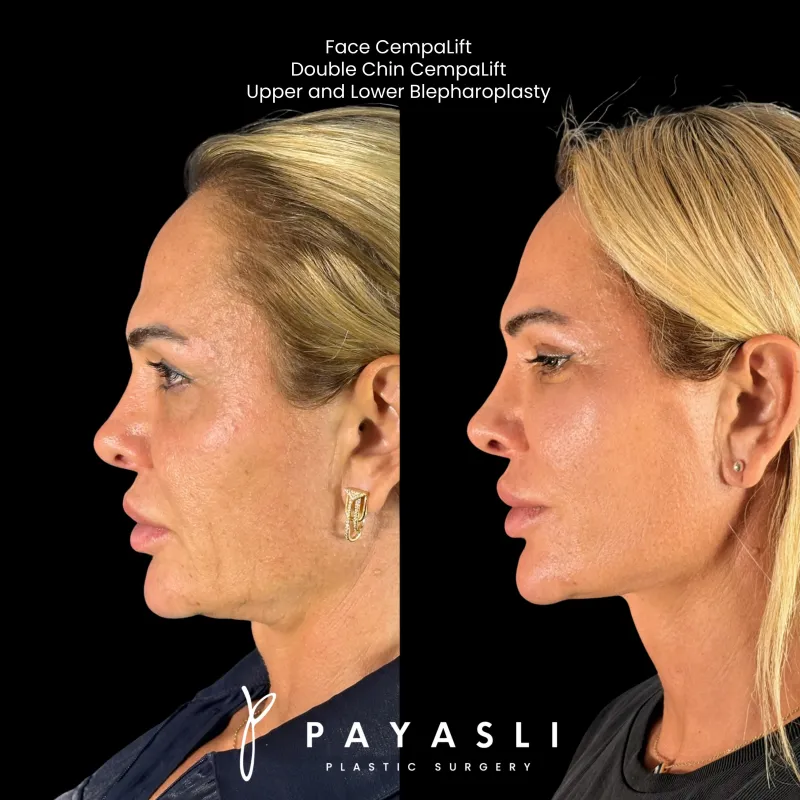 Before and after — Dr. Cem Payaslı